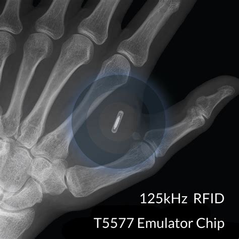 rfid chip implants 2019|On Emerging Technology: What to Know When Your Patient Has .